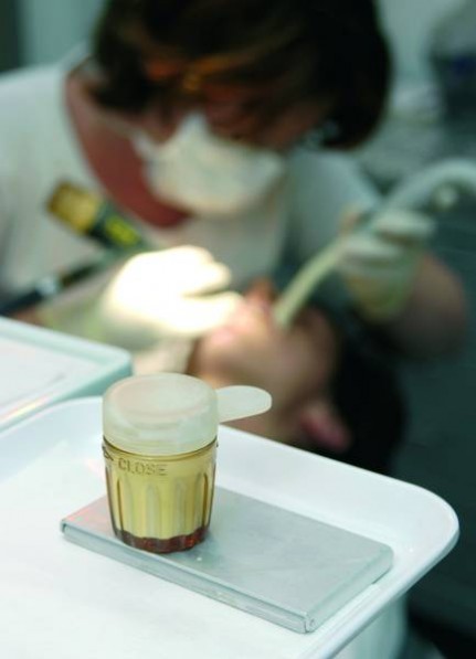 Fluoridierung im Rahmen der professionellen Zahnreinigung