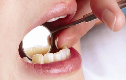 Überprüfung der Zahnsteinbildung an den Frontzähnen