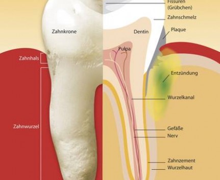 Die Entzündung in der Tiefe kann besonders gut durch den Laserstrahl errreicht werden Lasertherapie am Zahn